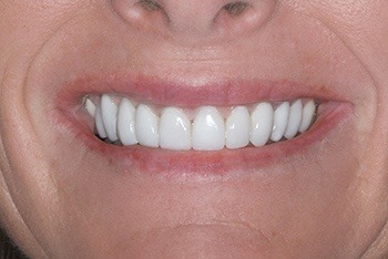 Closeup of female patient's flawless smile after treatment