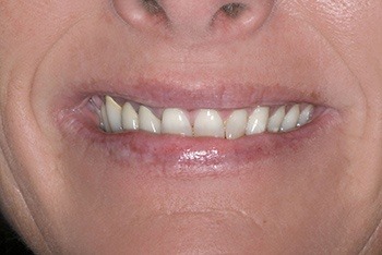 Closeup of femal patient's smile before treatment