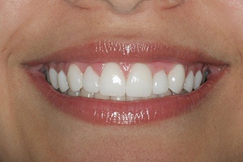 Closeup of young woman's perfectly aligned teeth