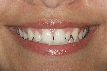 Closeup of young woman's unevenly spaced teeth