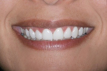 Closeup of woman's perfectly aligned smile