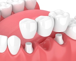 Animated dental bridge placement