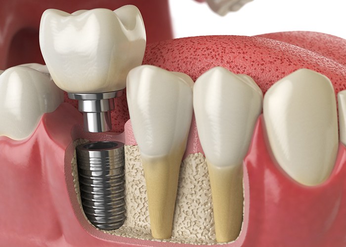 Diagram showing model of a dental implant in Louetta