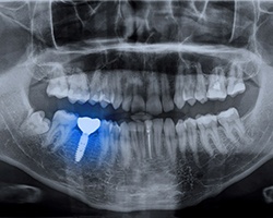 X ray of a person with a dental implant in Louetta