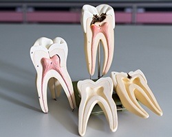 Models of the insides of teeth before and after root canals