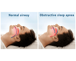 A man with sleep apnea