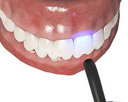 Illustration of dental bonding in Louetta, TX