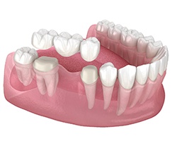 Illustration of a traditional dental bridge in Louetta Texas