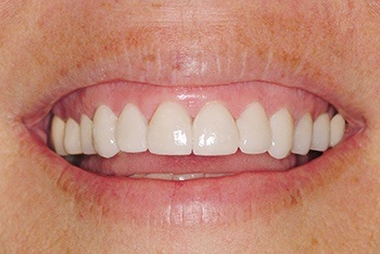 Closeup of beautiful smile after treatment