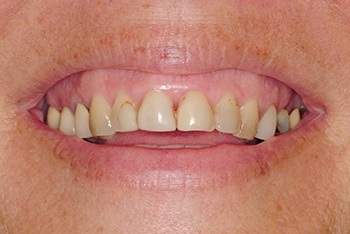 Closeup of yellow teeth before treatment