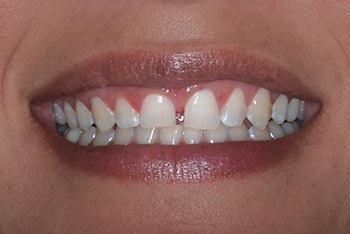 Closeup of smile with gap between front teeth
