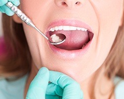 Closeup of mouth during metal-free dental restoratin placement