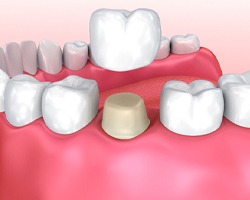 Animated dental crown placement