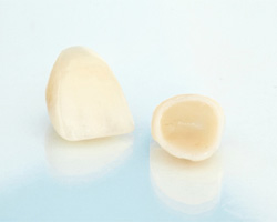 A close-up of metal-free dental crowns