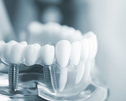 Model of dental implants in Houston