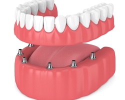 Dental implants and dentures in Louetta
