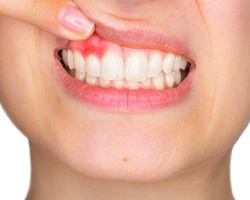 Woman showing red gums prior to periodontal therapy