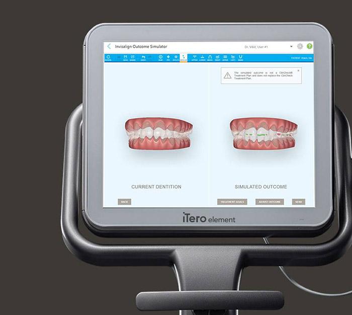 Digital bite impressions and dental restoration design on computer screen
