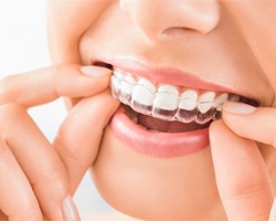 Woman placing Invisalign tray