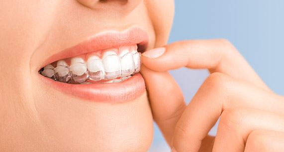 Invisalign special coupon