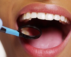 Closeup of smile with tooth-colored fillings