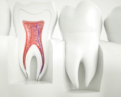 Root canal model