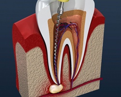 Animated root canal process