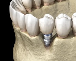 Illustration of receding bone around dental implant