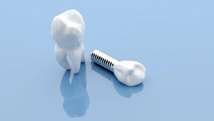 dental implant