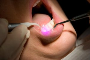 Dental Laser