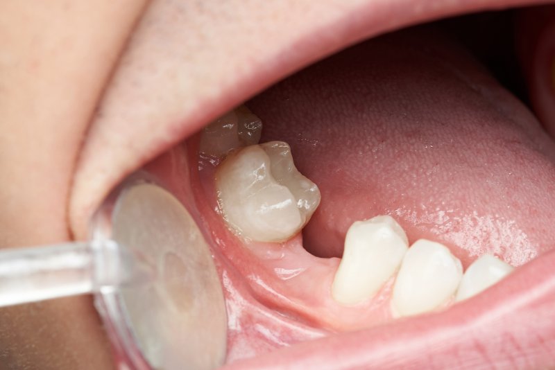 Dentist using dental mirror to look at patient's missing tooth