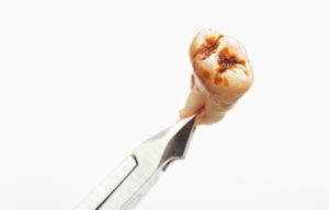 Decayed tooth on white background 