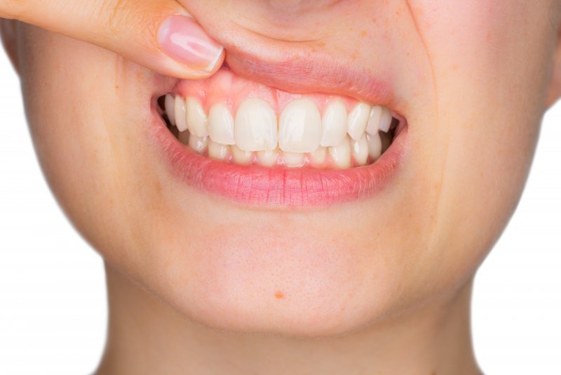 closeup of woman showing off gums