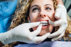 a woman getting Invisalign placed on just her top teeth