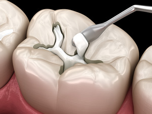 Illustration of a tooth-colored filling being applied