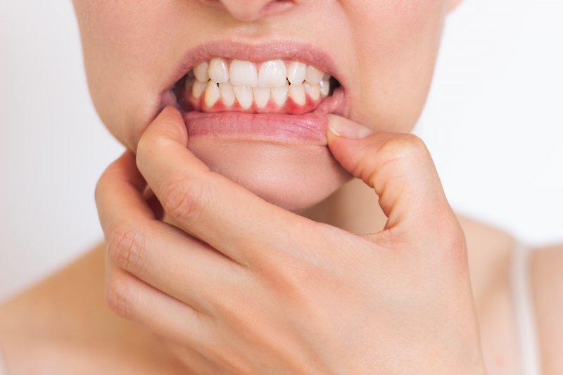 A young woman showing inflamed gums